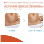 Curativo de Silicone para Cicatrizes (1 Unidade) – Cremer